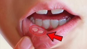 Canker sores