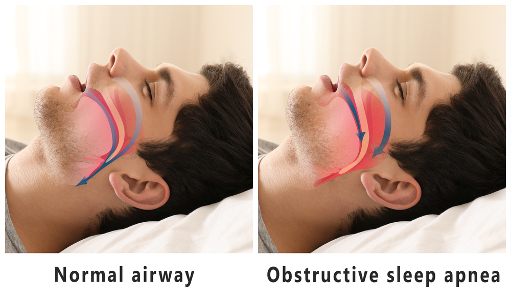normal airway vs obstructive sleep apnea example