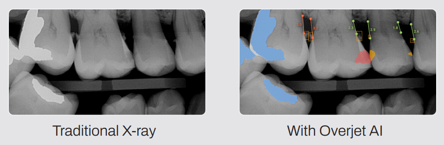 Traditional x-ray vs. Overjet AI.